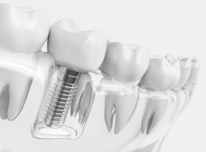 Missing a tooth? Learn what really happens if you don’t replace it and why dental implants are the best long-term solution for your smile, bone health, and bite.